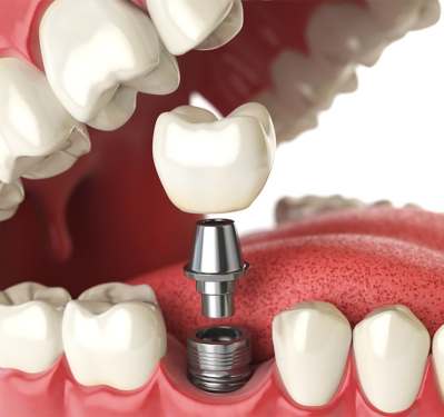Implantes Dentários